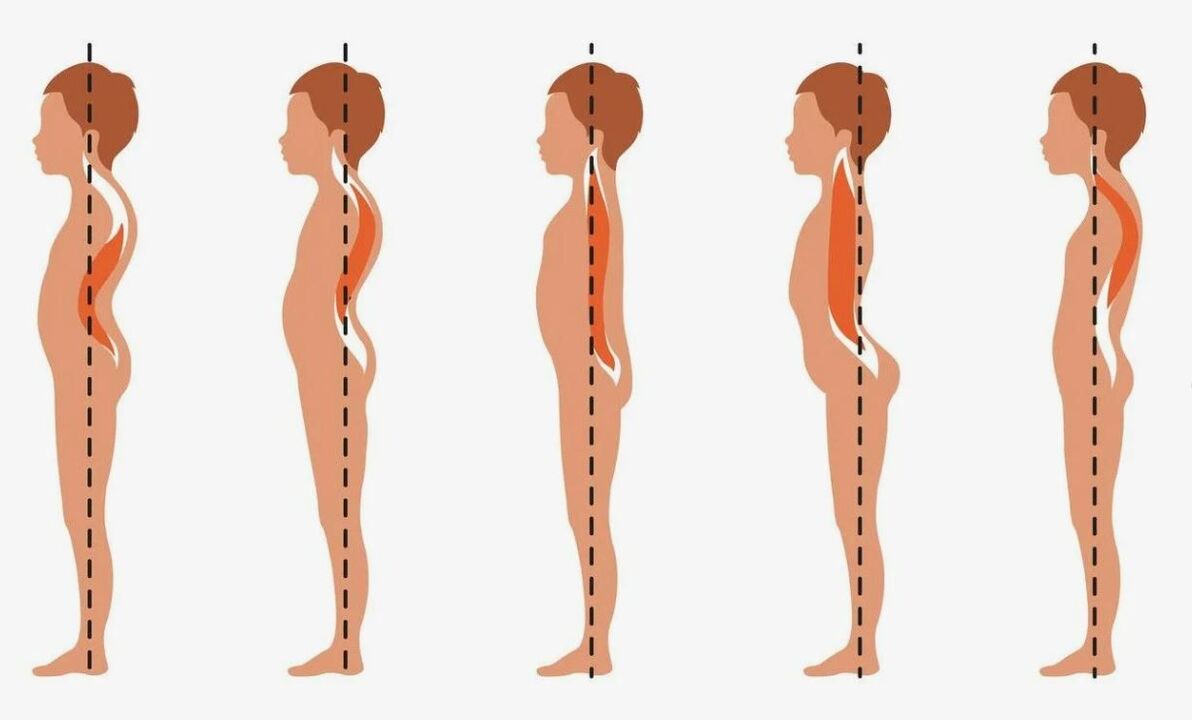 Grao de desenvolvemento da osteocondrose lumbar