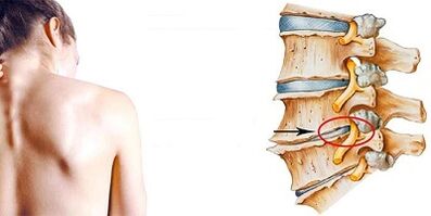 O mecanismo de desenvolvemento da osteocondrose cervical