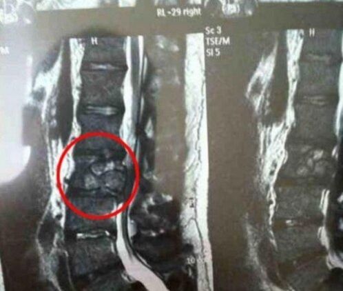 O tumor de sala vertebral na imaxe