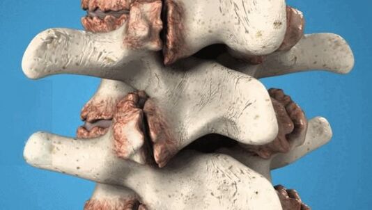 Osteófitos das vértebras - crecemento patolóxico que danan os nervios e os vasos sanguíneos
