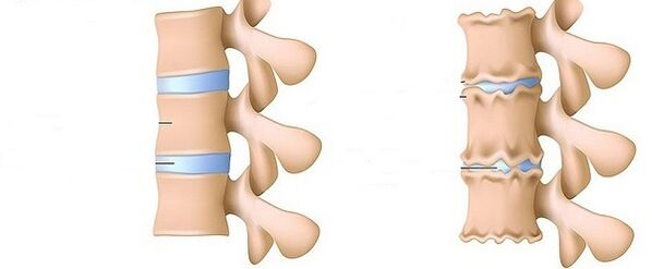 Columna vertebral saudable e osteocondrose