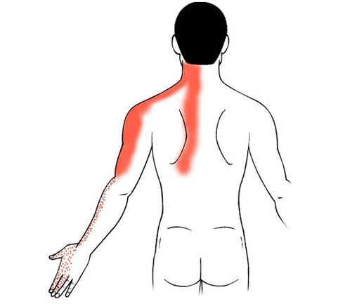 osteocondrose cervical como causa de dor nas articulacións dos dedos
