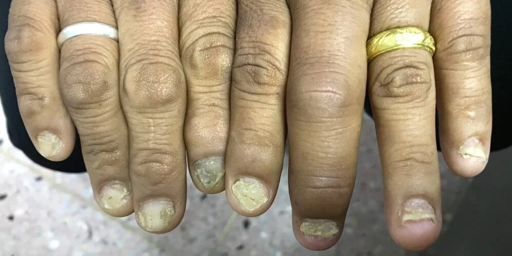 O inchazo dos dedos e a deformación da placa ungueal poden indicar o desenvolvemento da artrite psoriásica