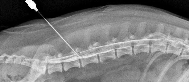 Bloqueo da columna con osteocondrose