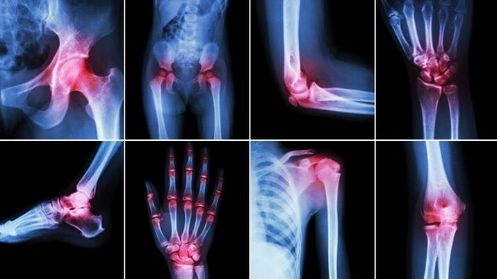 Articulacións do corpo afectadas pola artrose