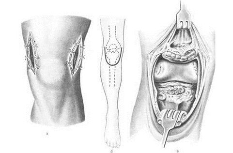 Cirurxía de artrotomía para osteoartritis